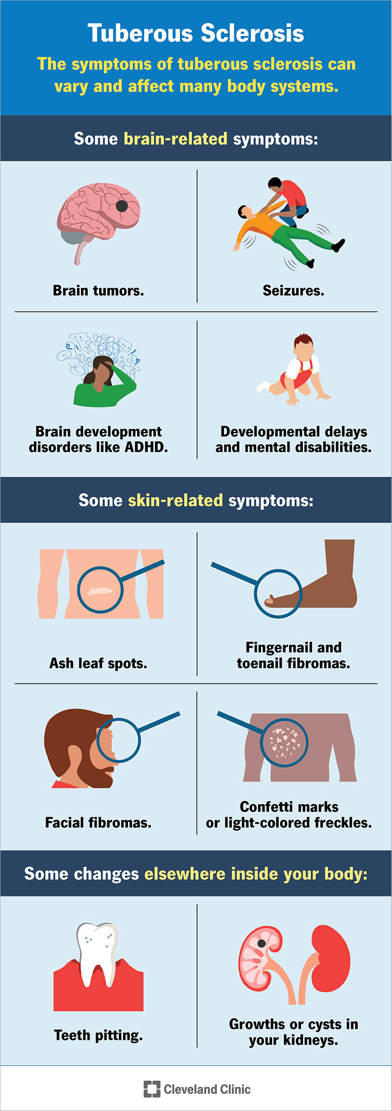 Tuberous sclerosis causes cells to grow out of control throughout your body, especially in your brain and on your skin.