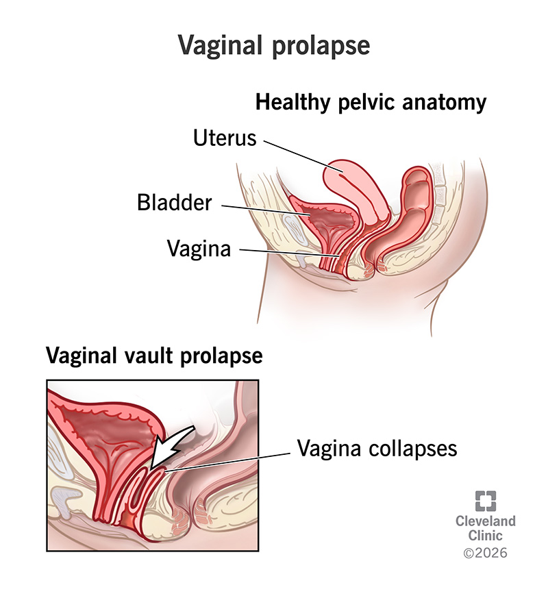 Healthy pelvic anatomy with vagina extending to the uterus, and vaginal vault prolapse with vagina folding in on itself