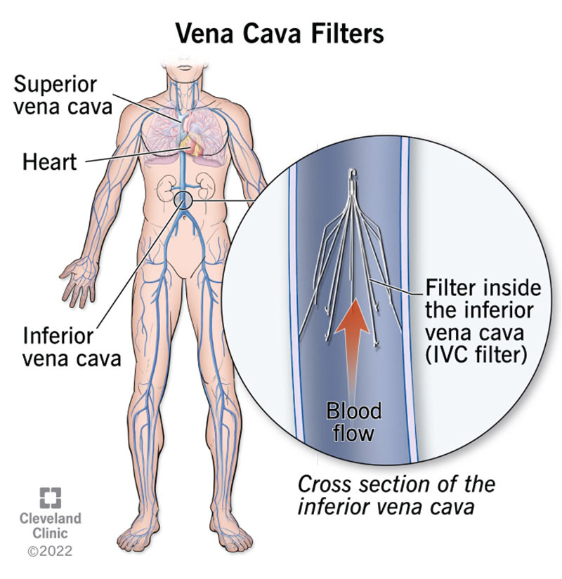 Cross section of inferior vena cava showing how vena cava filter stops blood clots from reaching lungs.