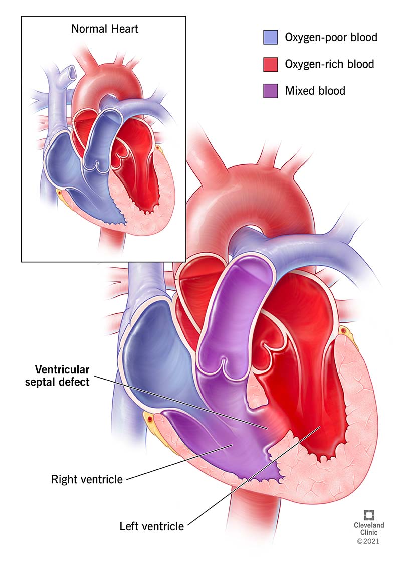 heart with ventricular septal defect (VSD)