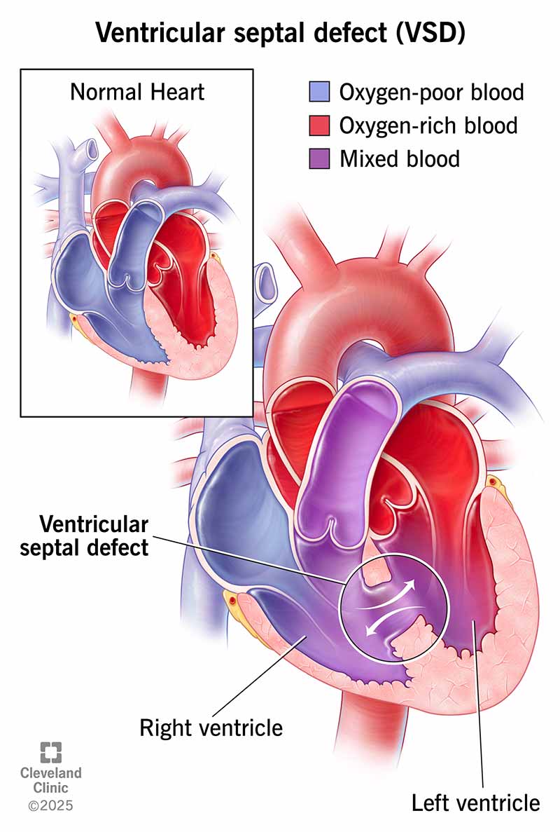 A VSD (hole in the wall between your lower heart chambers) allows oxygen-poor blood to mix with oxygen-rich blood