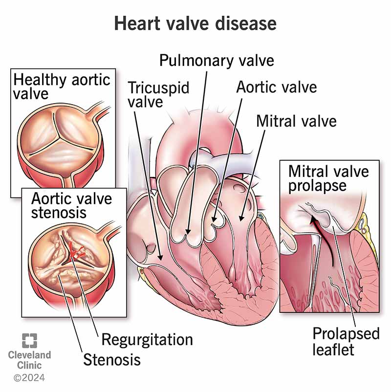 Heart valve disease includes a narrow, leaky or stretchy valve that doesn’t open and close correctly