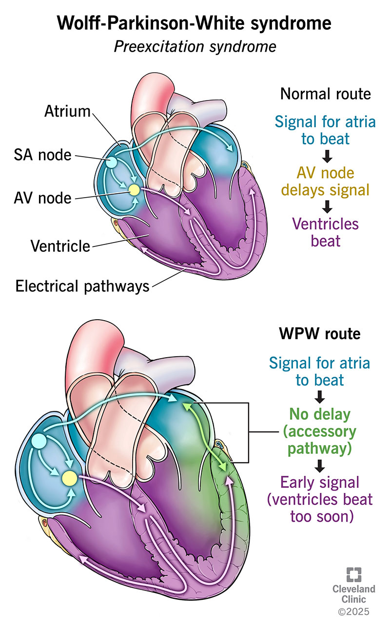 Your heart beats too quickly if you have Wolff-Parkinson-White syndrome.