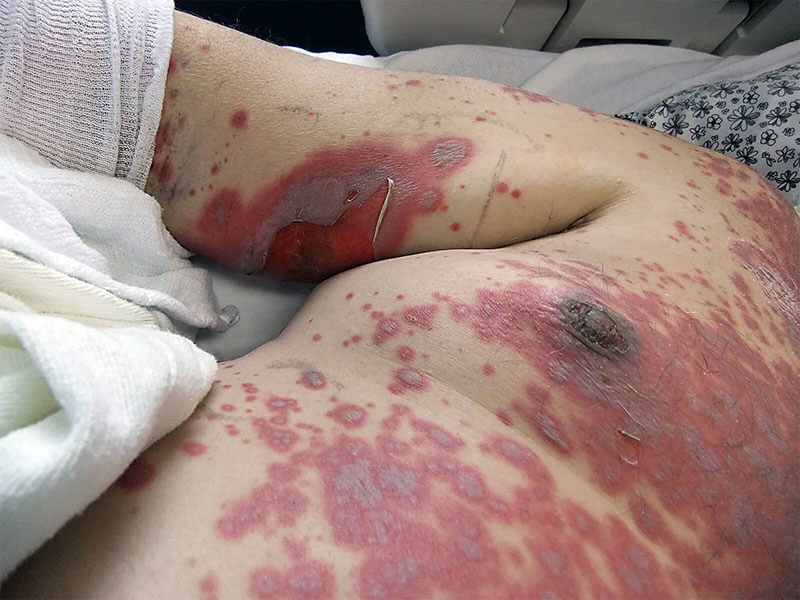 stevens johnson syndrome mild rash