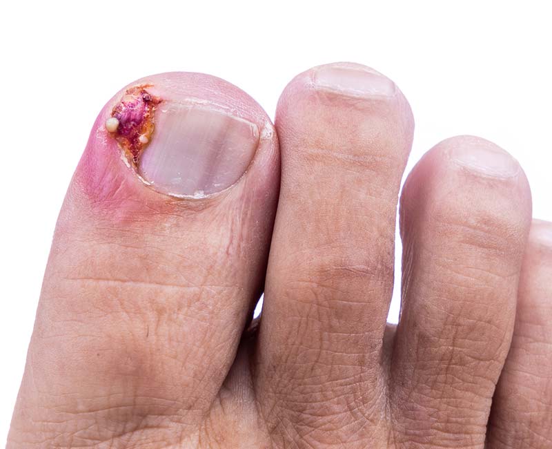 Redness, swelling and pus coming from your toe are signs of an ingrown toenail infection.