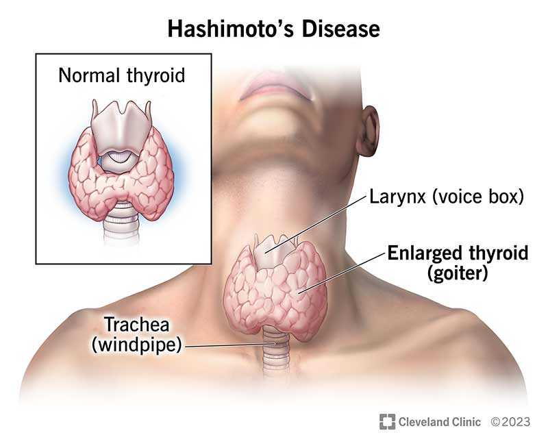 Illustration showing enlarged thyroid around the larynx and trachea in the neck compared to a normal thyroid.