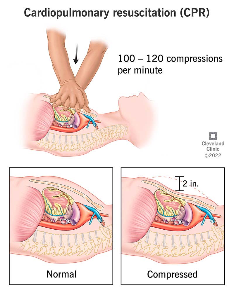 Chest compression methods used in the trial: (A) Standard position