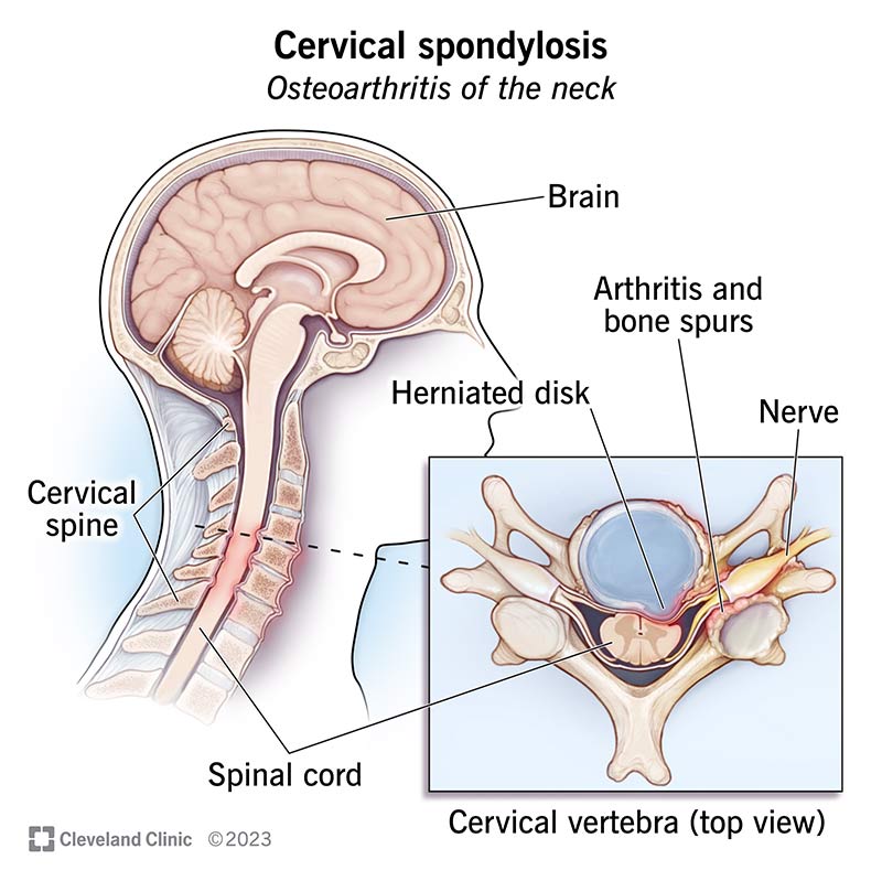The spine consists of 24 vertebrae. Cervical spondylosis affects one or more of the top seven vertebrae of the spine.