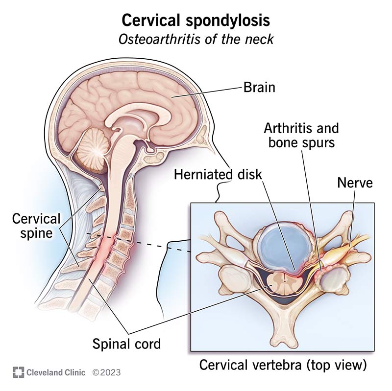 Neck Pain: Causes, Treatment, and When to See a Healthcare Provider