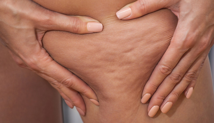 Hard Cellulite: What Is It and How to Get Rid of It