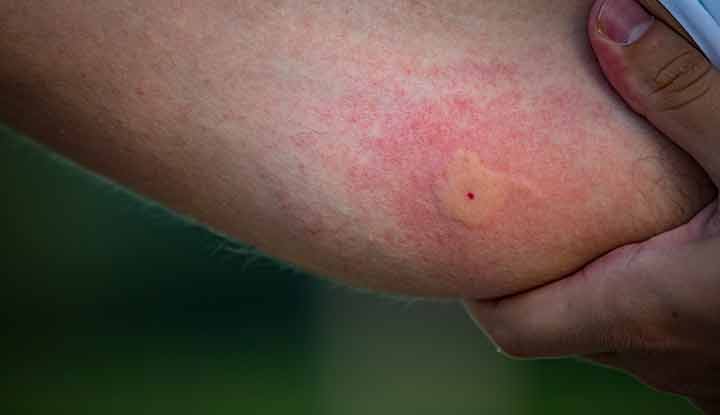 mosquito laying eggs in skin