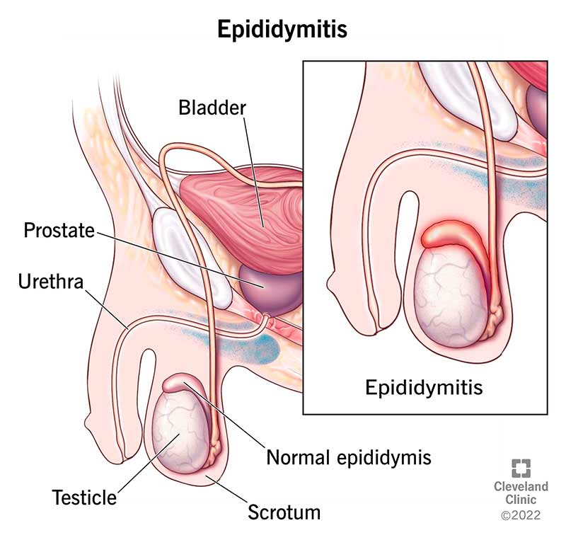 healthy epididymis vs epididymitis