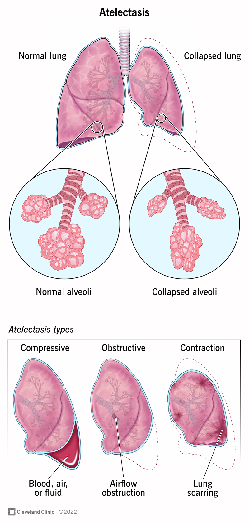 Illustration of fully inflated lung and lung affected by atelectasis. Atelectasis makes alveoli appear deflated.