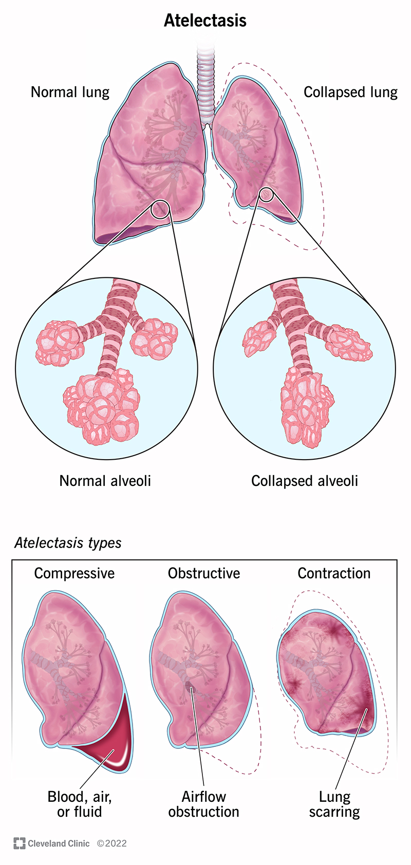 Atelectasis Causes Symptoms Diagnosis Treatment