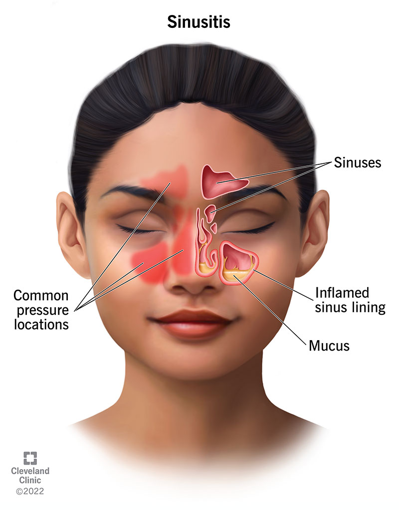 Illustration showing inflamed, fluid-filled sinuses. Common pain or pressure points are in your forehead, cheeks and nose.