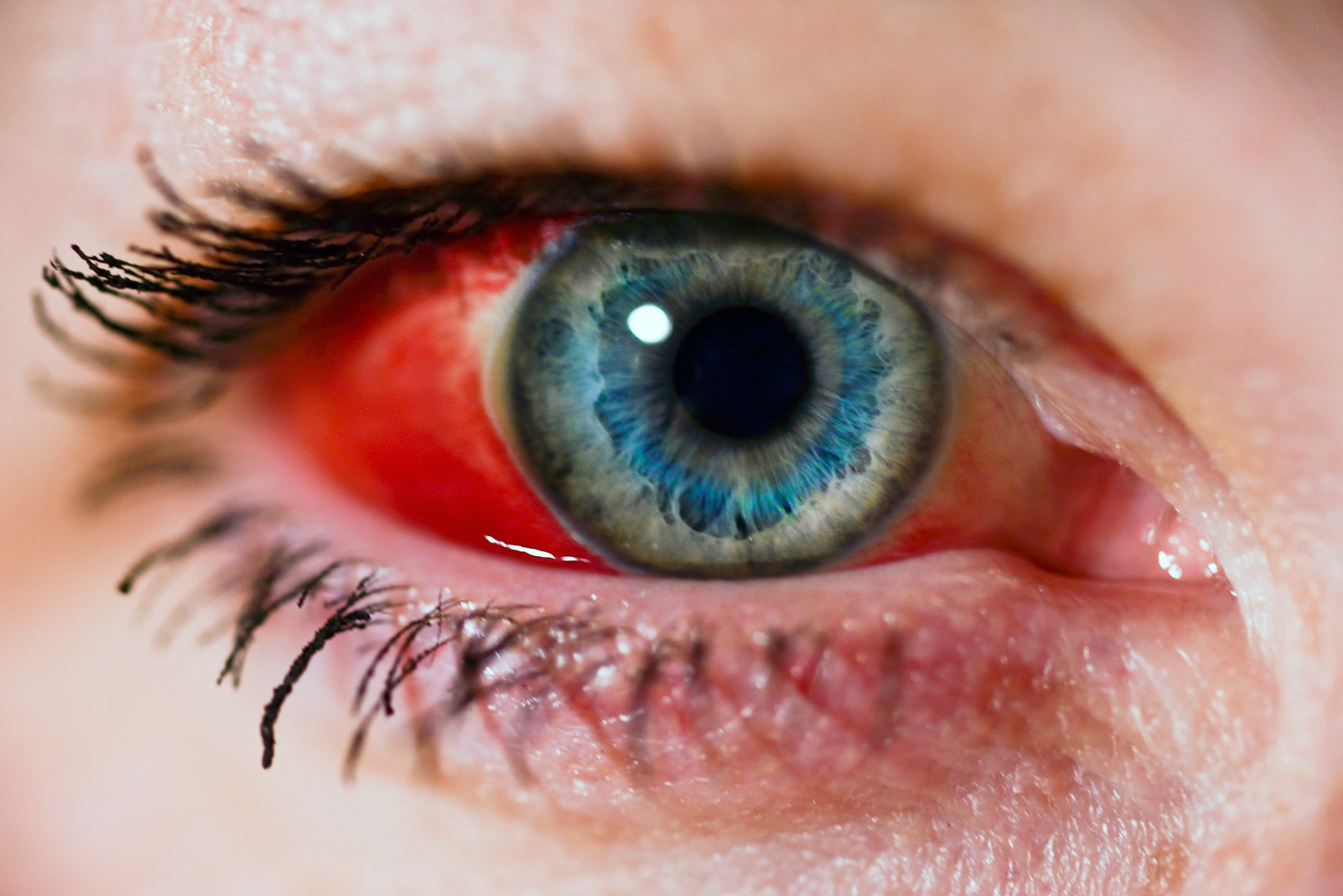 A subconjunctival hemorrhage on the surface of a person’s eye.