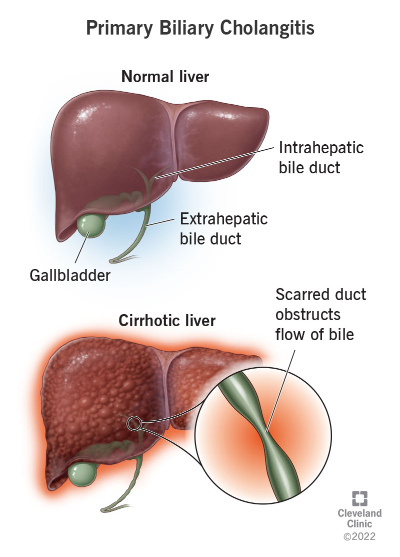 Primær galdecholangitis