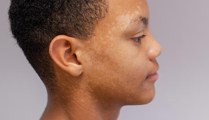 Tinea versicolor on the side of a dark-skinned child’s face and neck.
