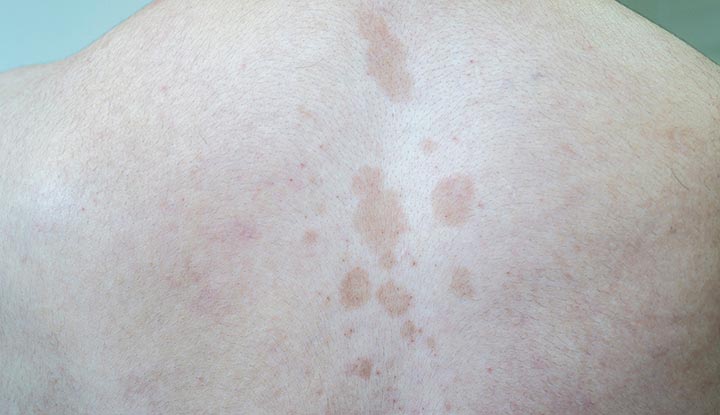 Tinea versicolor in the middle of a person’s upper back.