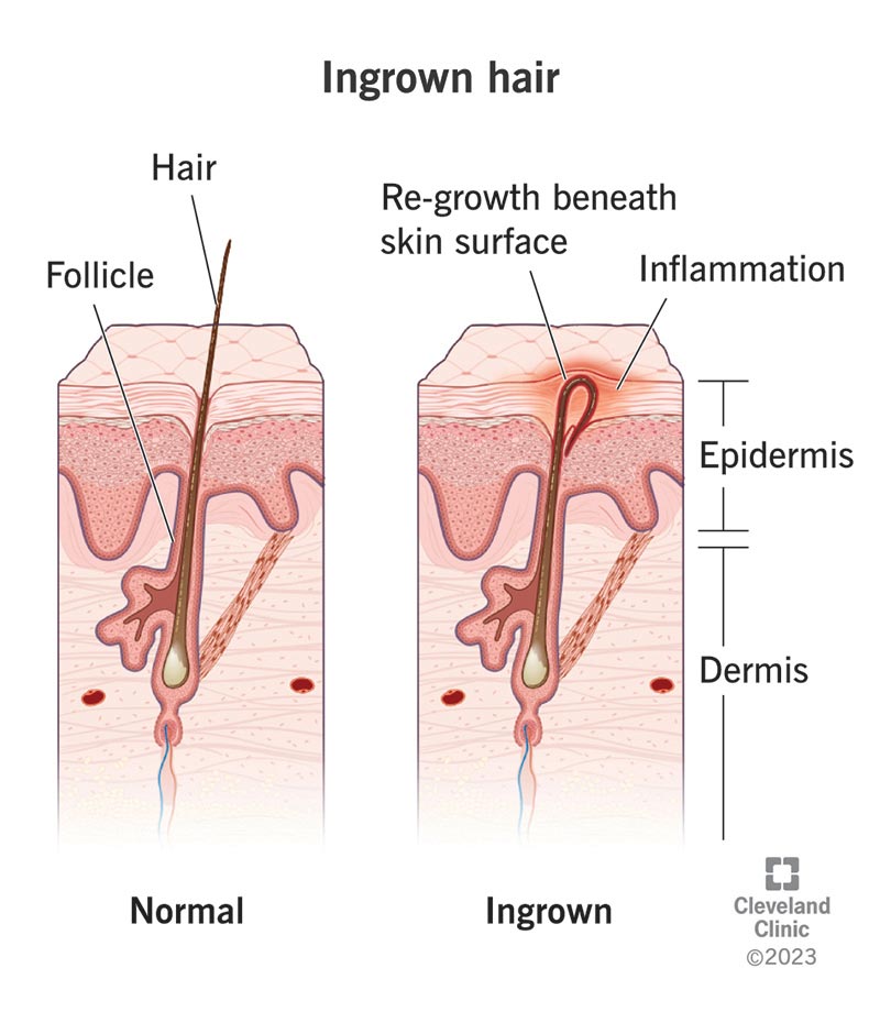 An ingrown hair looks like a small, discolored bump with hair in the middle. 