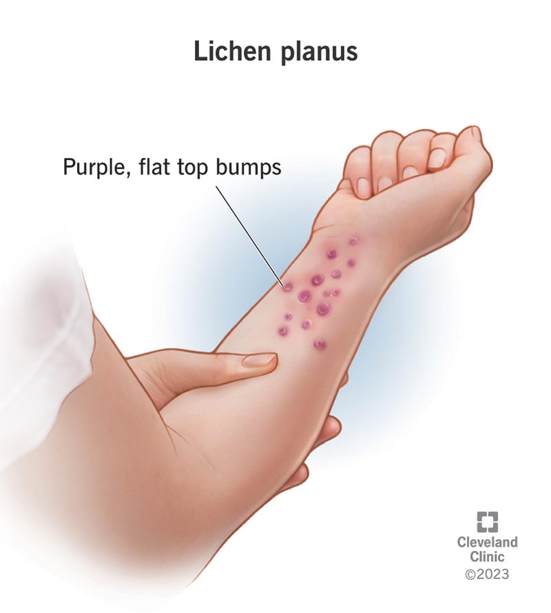 Lichen planus on the skin looks like a rash made up of small, discolored dots.