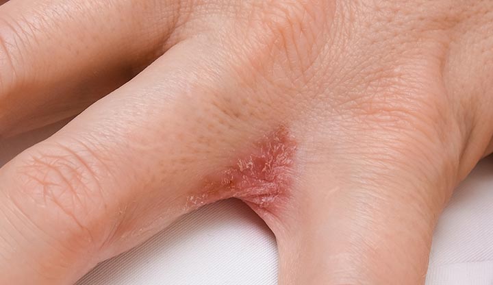 Dyshidrotic eczema forms on the skin between a person’s fingers.