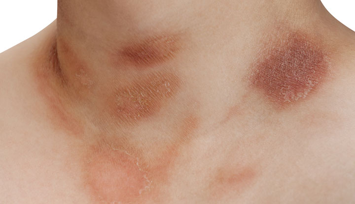 causes of rash purple