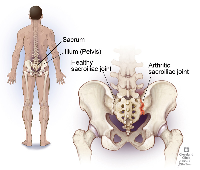 Illustration of the sacrum, ilium and sacroiliac joints.