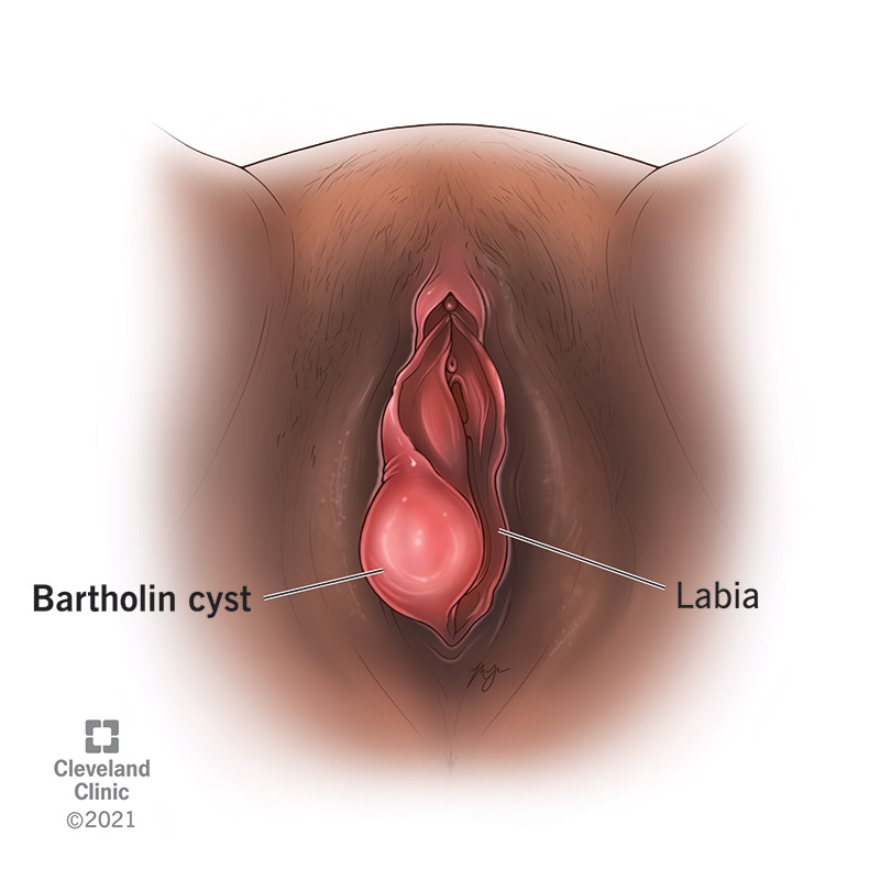 A Bartholin cyst developing on the Bartholin gland on the labia.