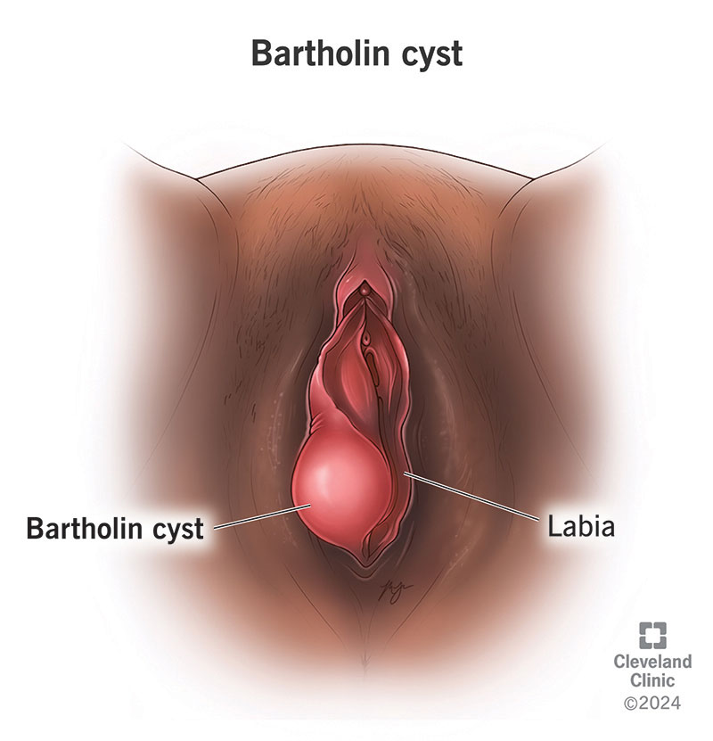 A Bartholin cyst developing on the Bartholin gland on the labia