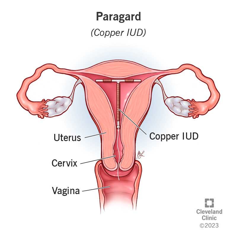 A T-shaped copper IUD inside a uterus.