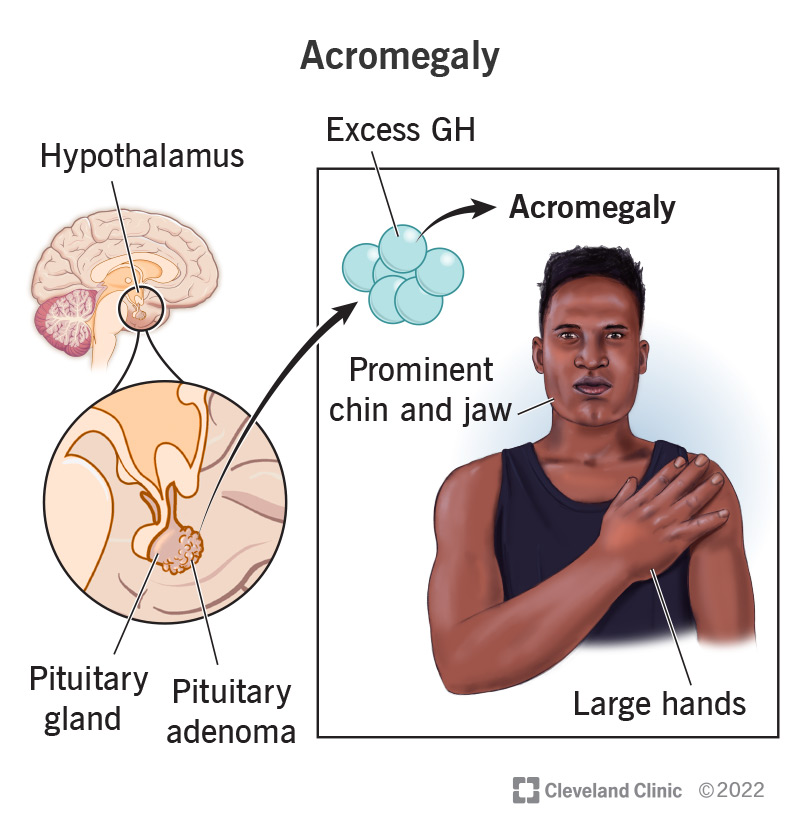 Pituitary gland with a pituitary adenoma on it and a man with a prominent chin and jaw and large hands.