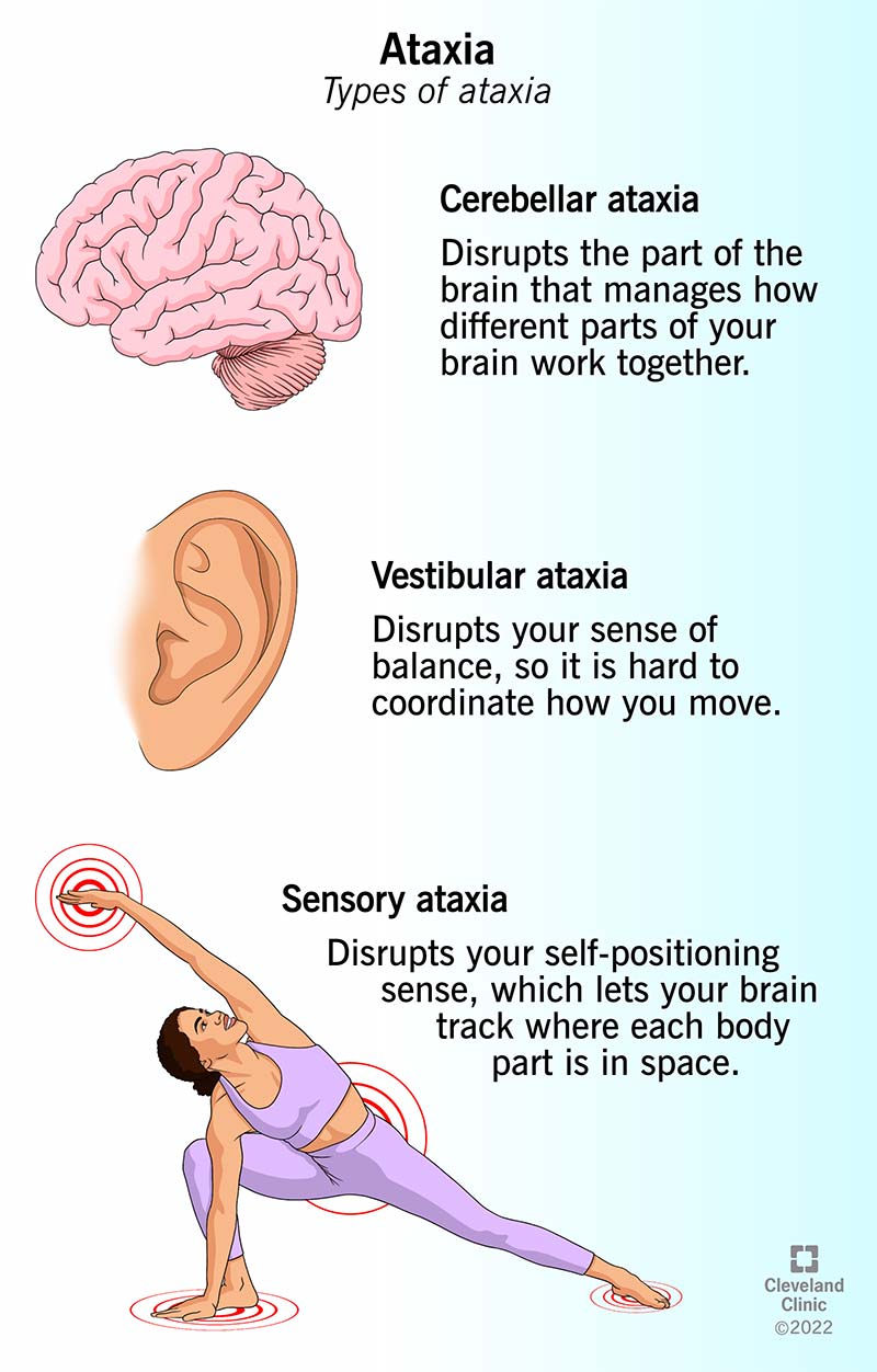 The three main forms of ataxia disrupt how your brain processes movement and senses the world around you.