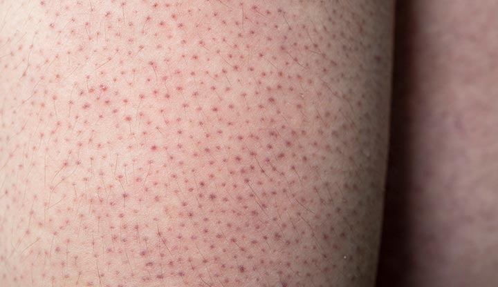 Keratosis pilaris are small, red bumps on the skin of your arms.