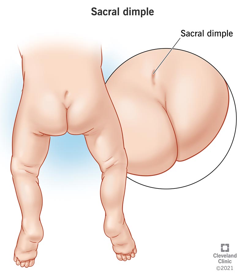 A sacral dimple is a small indentation in your newborn’s lower back near the crease of their buttocks.