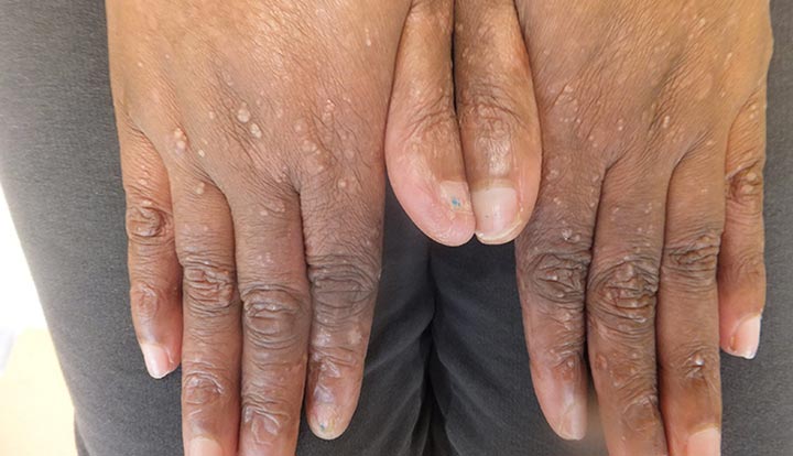Friction or injuries can cause epidermolysis bullosa blisters to form. In mild cases of EB, the blisters may form on your hands.