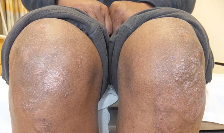 Friction or injuries can cause epidermolysis bullosa blisters to form. In mild cases of EB, the blisters may form on your knees.