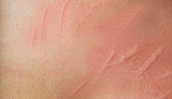 Raised Skin Bumps: Pictures, Symptoms, Causes, Treatments