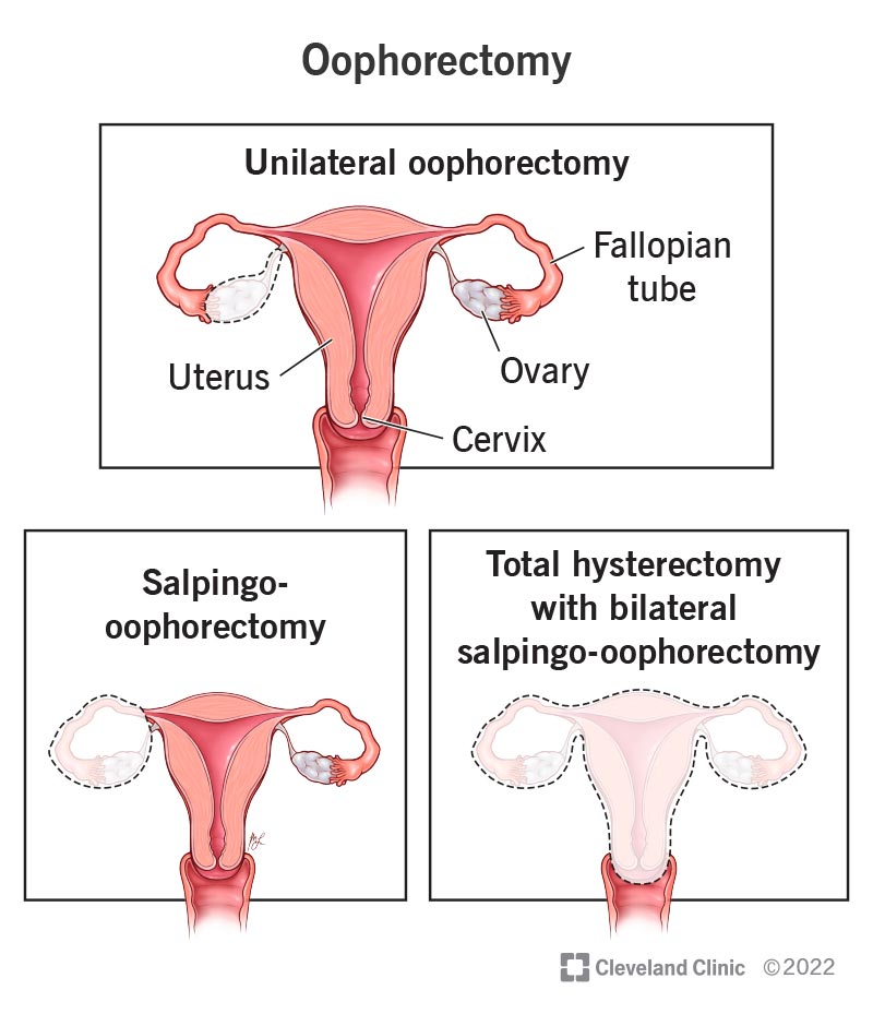 Three examples of types of oophorectomy surgery (procedure to remove one or both your ovaries).