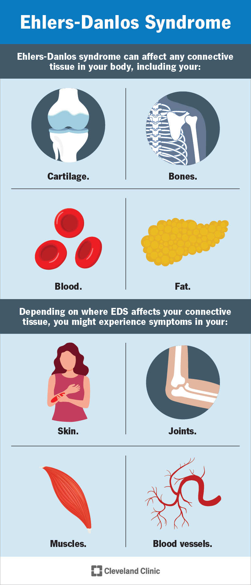 Ehlers-Danlos syndrome can affect tissue throughout your body and cause many different symptoms.