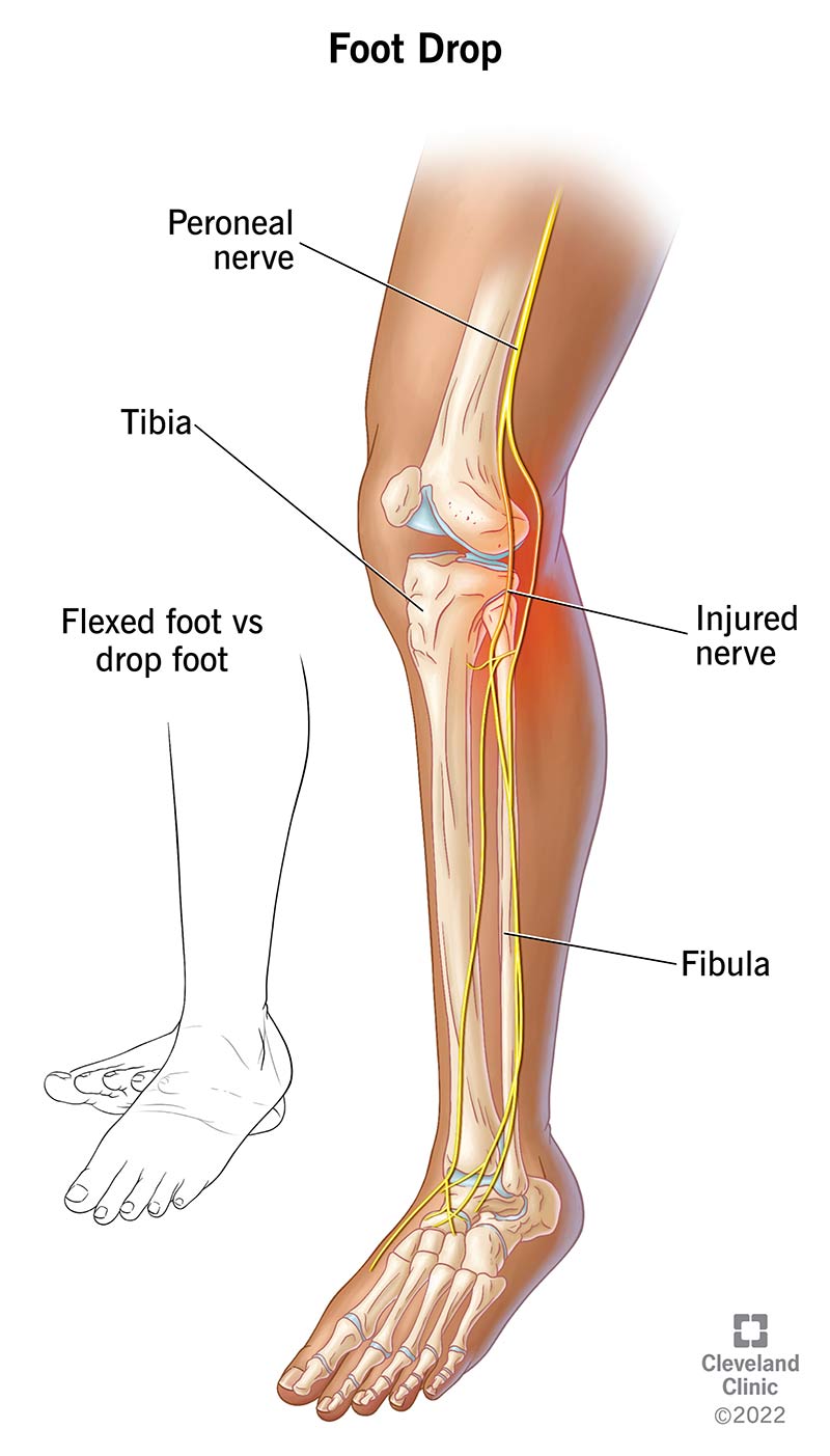 Illustration of leg bones & peroneal nerve. Injuries common around knee & ankle.