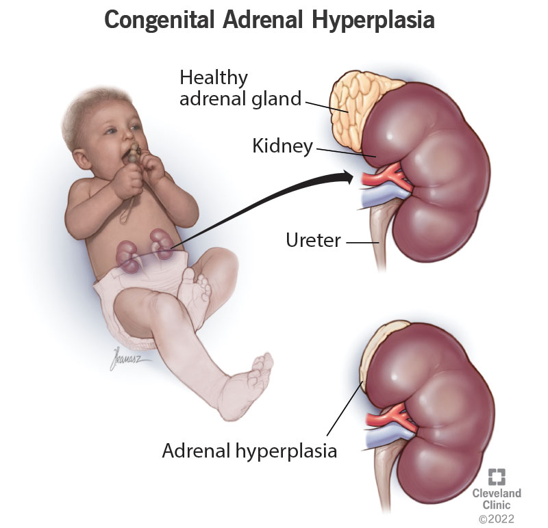 congenital adrenal hyperplasia women