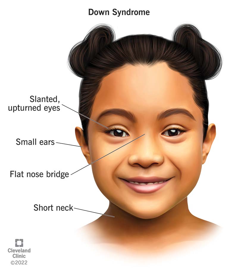 A child diagnosed with Down syndrome has physical characteristics of the condition.