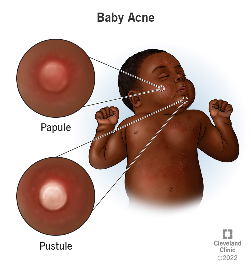 An infant with baby acne and two magnified images of a papule and a pustule.