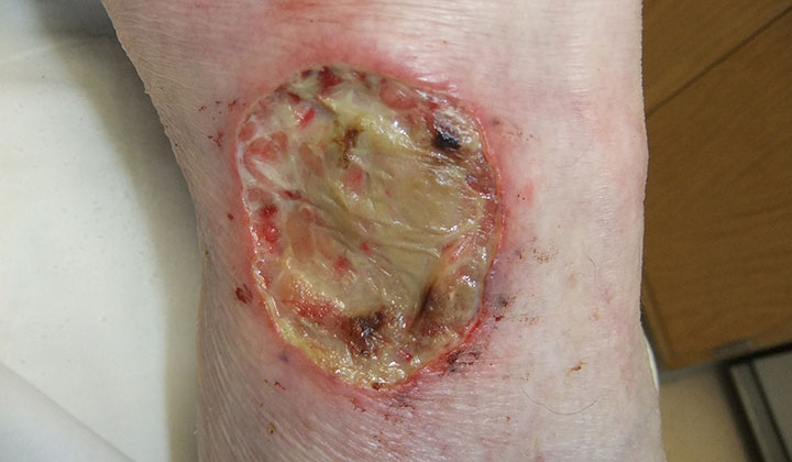 A large, open, white/gray pyoderma gangrenosum ulcer with a raised red border.