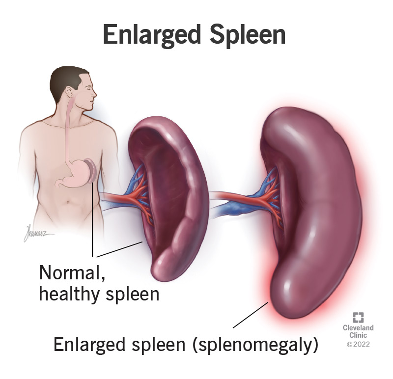 Illustration of normal-sized spleen vs. enlarged spleen.