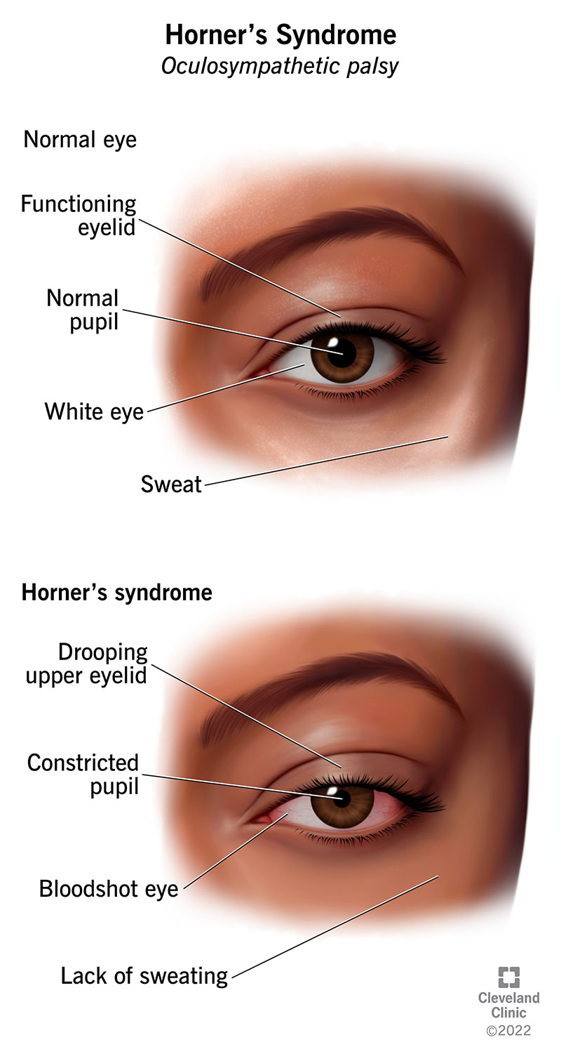 Symptoms of Horner syndrome include a drooping upper eyelid, constricted pupil, bloodshot eye and a lack of sweating in the affected area.