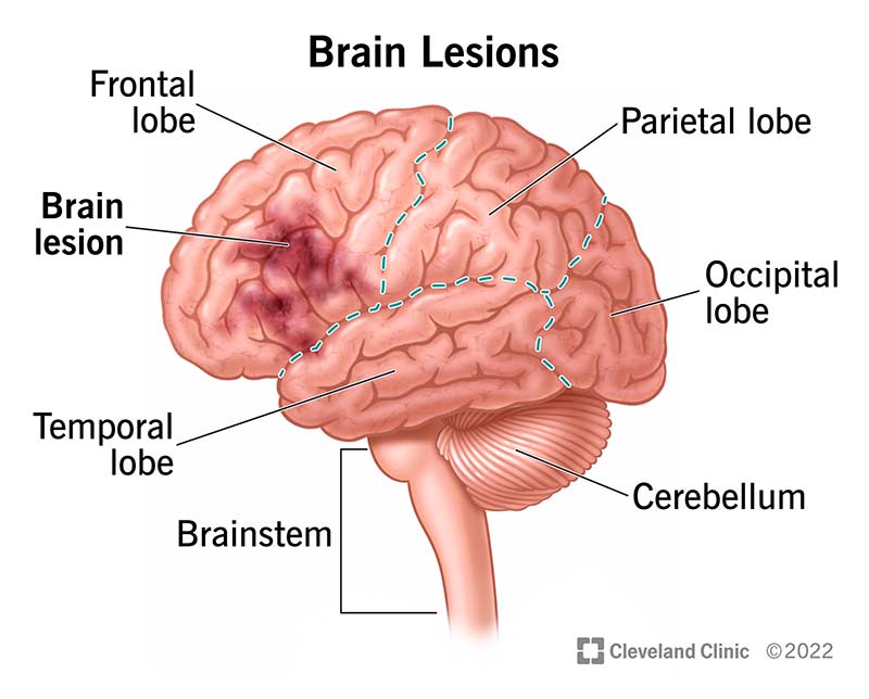 Brain lesions are damaged areas of your brain. The cause, location and severity of the lesion determine the effects.