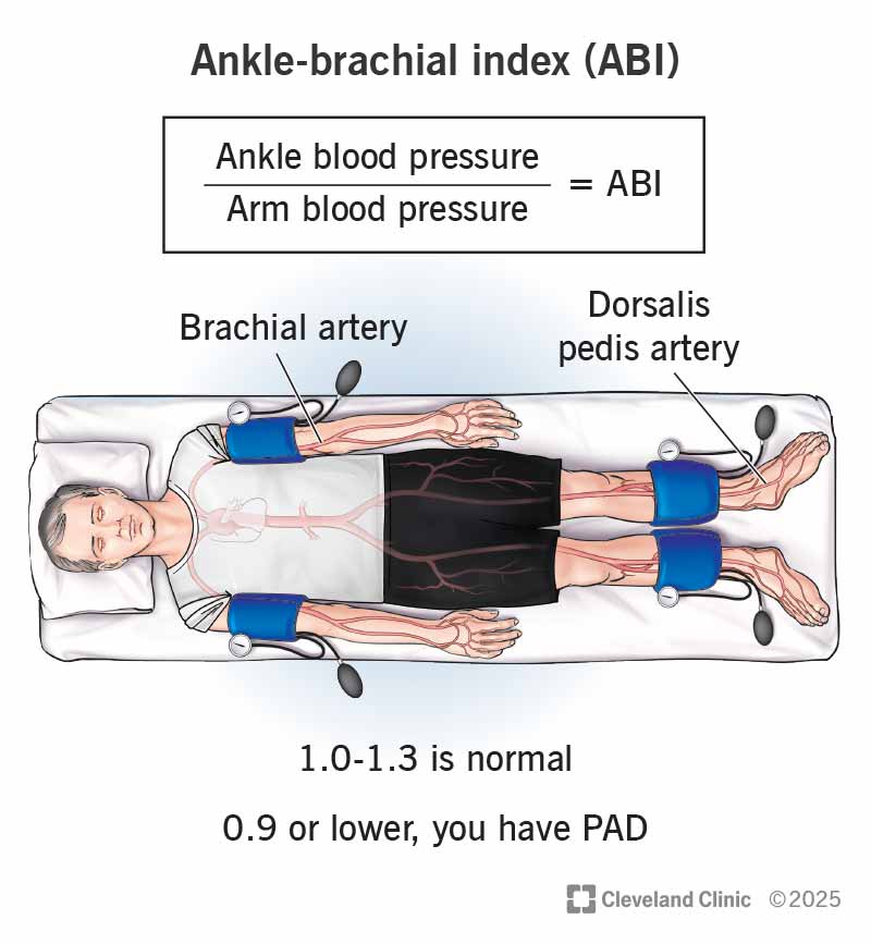 Your provider measures blood pressure in your arms and ankles and uses these numbers to calculate your ankle-brachial index