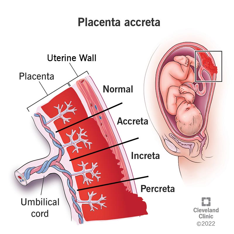 Illustration of a placenta embedding in a uterine wall when a person has placenta accreta, increta or percreta.